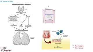 14 Thyroiditis part 1  Hashimoto