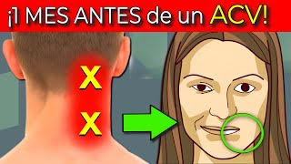 7 SEÑALES de ADVERTENCIA 1 MES ANTES DE UN ACV| ICTUS CEREBRAL