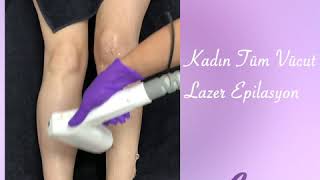 Kadın Tüm Vücut Lazer Epilasyon Uygulamamız / Love Beauty Center