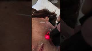 Transgender male to female  getting Laser Hair Removal on Face