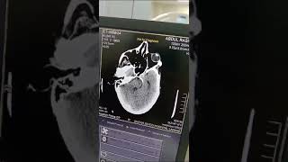 Embolic MCA infarct with Hemorrhagic  Transformation and IVE in Warfarin Using Patient #stroke