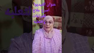 العلاج السريع الفراغات والثعلبه كلنا عرفنها