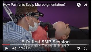 How Painful is Scalp Micropigmentation?