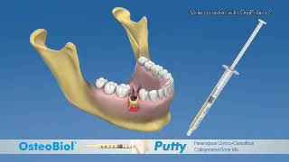 Лечение периимлантита с OsteoBiol Putty