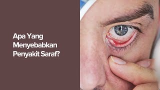 Apa yang Menyebabkan Penyakit Saraf?