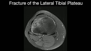 Fracture of the Lateral Tibial Plateau