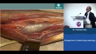 MANAGEMENT OF DISTAL BICEPS PATHOLOGY