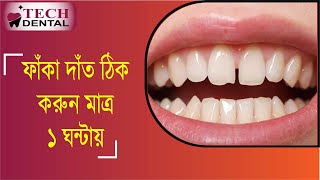 ফাঁকা দাঁতের সমাধান মাত্র ১ ঘন্টায় । Tech Dental