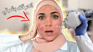 رحت على اغلى مراكز التجميل / انحرق وجهي  بالليزر  😰