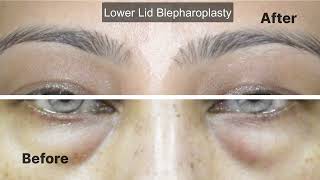 Experience the transformative power of lower lid blepharoplasty!