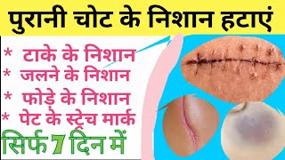 ScarEnd Gel Benefits,dosage,Side effect।पुरानी चोट के निशान व दाग, हटाए। Chot Ke Nishan Kaise hataye