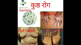 Leprosy disease short knowledge