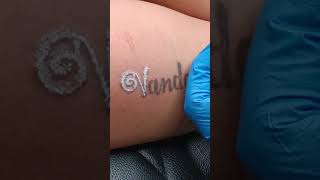 Tattoo Removal In Ahmedabad #ytshorts #shorts #trending #youtuber #viral #tattooremoval