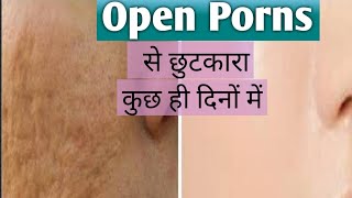 Open pores से छुटकारा कुछ ही दिनों में open pores khatam kisa Kara.how to fill open pores naturally.