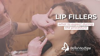 Lip Fillers - what to expect during the procedure | Bella MedSpa