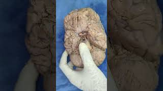 Meninges of Brain, Base of Brain, Blood vessels | Brain Prosection Specimen |Anatomy Decoded