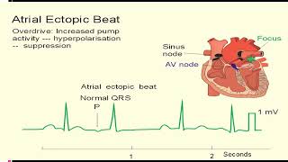 EKG itu Gampang Sesi 3(Aritmia Dasar)