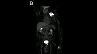 B Cell Lymphoma