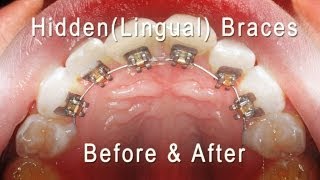 How to fix a single twisted tooth with lingual braces