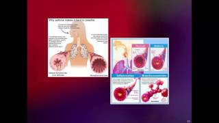 Oxygenation Concept - Asthma