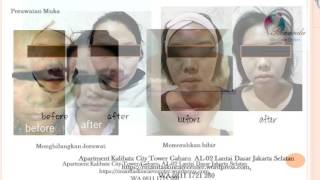 0811 1721 280, Cara Dagu Terbelah di Jakarta Selatan Rinanda  Skin Care Center