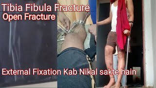 External Fixation Kaise Nikalte Hain||Tibia Fibula Fracture Recovery||Skin Grafting