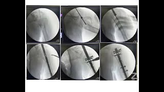 IM Nailing in Proximal Humerus fractures: Michell Ruiz, MD