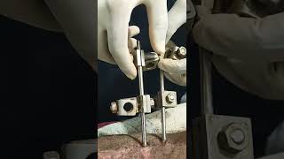 Removal of Ao Fixator Pins 📌 #fixation #ortho #osteoporosis #hospital #doctor #patient #shorts #fyp