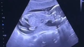 ultrasound of baby moving in womb