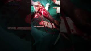 Brachial artery tear due to trauma