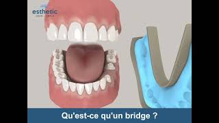 Qu'est-ce qu'un bridge dentaire ? Esthetic Hair Smile