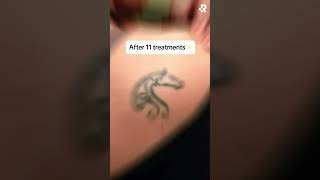 Before & After Tattoo Removal at Removery!🤩