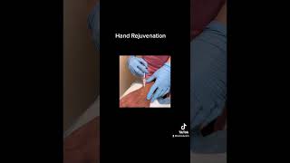 Hyperdilute Radiesse Hand Injections