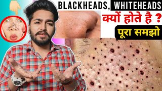 Blackheads, Whiteheads क्यों होते है | अच्छे से समझो