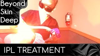 IPL TREATMENT ✨ Before & After Immediate Results! (Part 1)