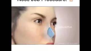 WOWWW Nose job procedure