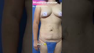 Mommy makeover in weight loss