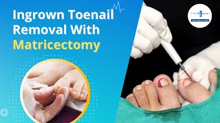 Say goodbye to the pain of in-grown toenails | Ingrown toenail removal with Matricectomy