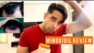 REGROW YOUR HAIR|| MARS BY GHC MINOXIDIL|| REVIEW