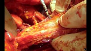 FIGO 2012: LIVE SURGERY Advanced Ovarian Cancer Part.3