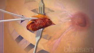 Biopsy I medical animation CTCA Cancer Videos