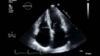 Practice Visual Estimation of Left Ventricular Ejection Fraction Atrial Fibrillation Echocardiogram