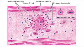 Aschoff nodules | acute rheumatic fever | pathology mbbs