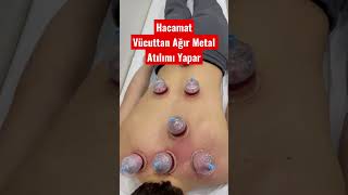 Hacamat  #otizm #hiperaktivite #kronikhastalıklar için faydalı bir tedavidir. #cupping #hijama