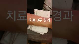 20대 남성 전신다한증 치료과정 #전신다한증 #안면다한증 #두근두근한의원