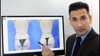 Brazilian Butt Lift in Beverly Hills How It's Done