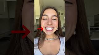 Perfect TEETH but still got braces!?