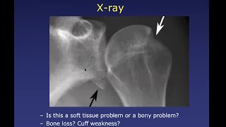 Anterior Shoulder Instability: Diagnosis and Planning