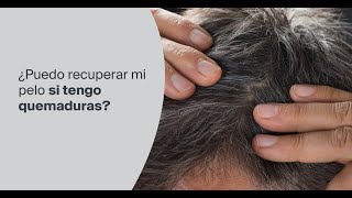 ¿Puedo recuperar mi pelo si tengo quemaduras?