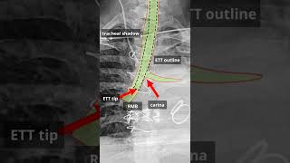 CXR Spot Diagnosis (Part 5) #cxr #mbbs #shorts #medical_snippet #radiology